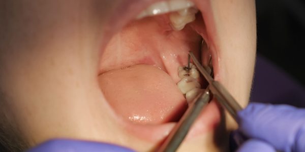 dentista-revision-caries