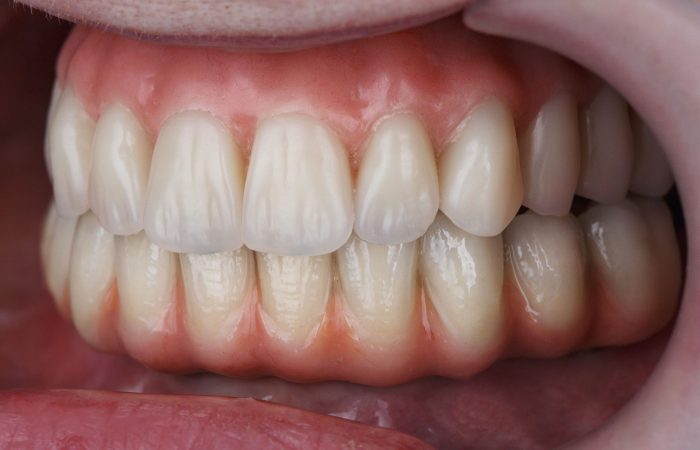 protesis-dental-maiquez (1)