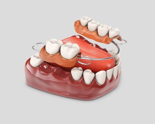 protesis-dental-maiquez (4)